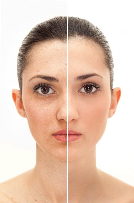 Hyperpigmentation? Here’s the Skincare Routine That Actually Works