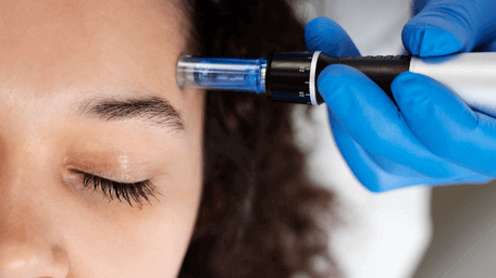 Microneedling