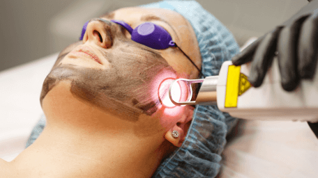 PICO Laser for Pigmentation (Body)