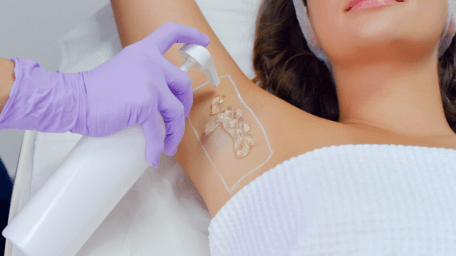 Laser Hair Removal