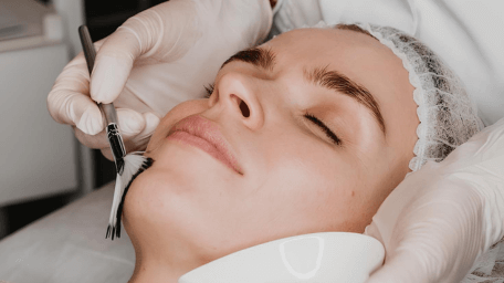 Chemical peel